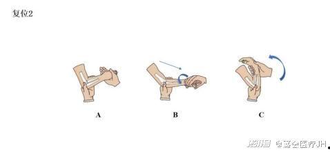 成人脱臼医生复位视频讲解,成人脱臼复位操作步骤详解