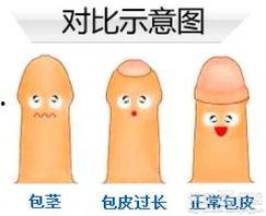 成人包茎如何处理方法视频,轻松解决私密困扰  第3张